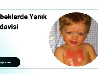 Bebeklerde Yanık Tedavisi: Güvenli Yöntemler