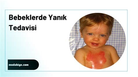 Bebeklerde Yanık Tedavisi: Güvenli Yöntemler Bebeklerde Yanık Tedavisi: Güvenli Yöntemler