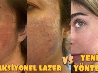 Lazer Sonrası Yanık Normal mi? Tedavi ve İyileşme Süreci