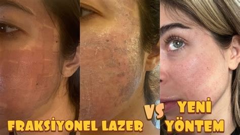 Lazer Sonrası Yanık Normal mi? Tedavi ve İyileşme Süreci Lazer Sonrası Yanık Normal mi? Tedavi ve İyileşme Süreci
