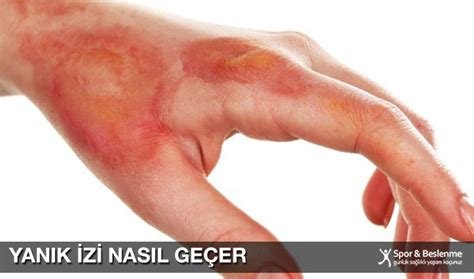 Mermer Yanık İzi Nasıl Geçer? Rehabilitasyon ve Temizlik Yöntemleri Mermer Yanık İzi Nasıl Geçer? Rehabilitasyon ve Temizlik Yöntemleri