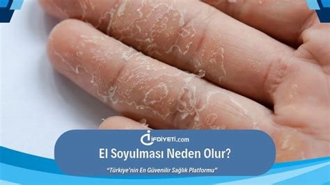 Yanık Derinin Soyulması: Ne Yapmalı? Yanık Derinin Soyulması: Ne Yapmalı?
