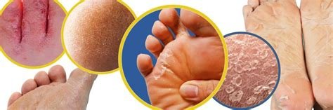 Yanık Derisi Soyulur mu? Soyulma ve Bakım İpuçları Yanık Derisi Soyulur mu? Soyulma ve Bakım İpuçları