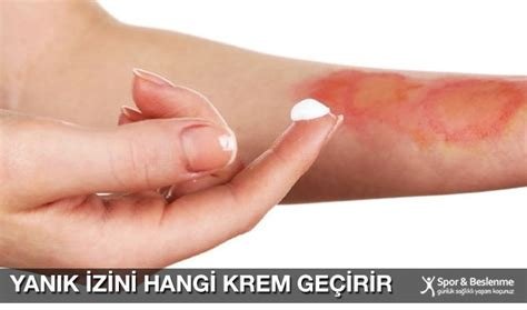 Yanık İzini Ne Geçirir? Kozmetik ve Doğal Çözümler Yanık İzini Ne Geçirir? Kozmetik ve Doğal Çözümler