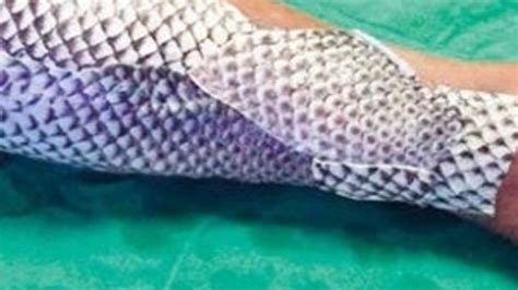 Yanık Tedavisinde Balık Derisi: Yenilikçi Yöntemler Yanık Tedavisinde Balık Derisi: Yenilikçi Yöntemler