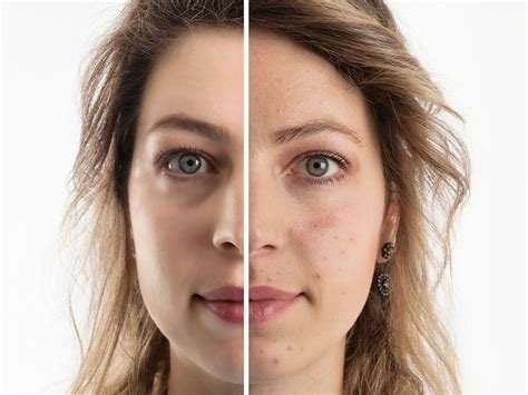 Yüzdeki Yanık İzi Nasıl Geçer? Estetik Çözümler Yüzdeki Yanık İzi Nasıl Geçer? Estetik Çözümler