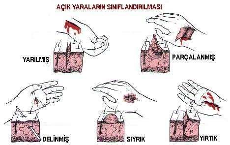 Yanık Olaylarında Kelimelerle Yapılan Yaralar: Psikolojik Yardım Yanık Olaylarında Kelimelerle Yapılan Yaralar: Psikolojik Yardım