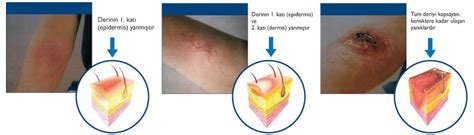 Asit ve Alkali Yanıkların Farklılıkları: Tedavi Yaklaşımlarını Karşılaştırın Asit ve Alkali Yanıkların Farklılıkları: Tedavi Yaklaşımlarını Karşılaştırın