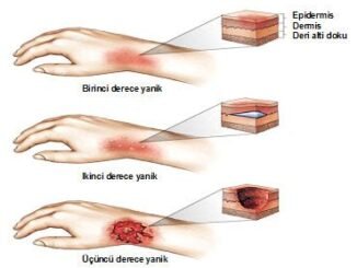 Birinci Derece Yanıklarda Cilt Onarımında Doğal Yağların Etkisi