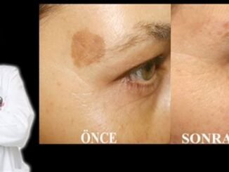 Dermatologlardan Yanık Tedavisine İlişkin Altın Değerinde Tavsiyeler