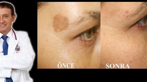 Dermatologlardan Yanık Tedavisine İlişkin Altın Değerinde Tavsiyeler Dermatologlardan Yanık Tedavisine İlişkin Altın Değerinde Tavsiyeler