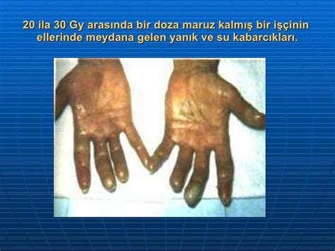 Radyasyon Yanıkları: Cilt Üzerindeki Etkiler ve Tedavi Süreci Radyasyon Yanıkları: Cilt Üzerindeki Etkiler ve Tedavi Süreci