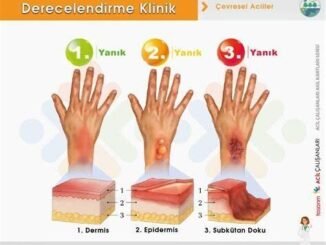 Yanık Belirtileri: 2. ve 3. Derece Yanıkların Farkları