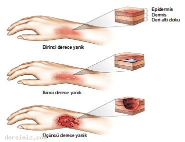 Yanık Tedavisi İçin İlk Yardım Setinizi Doğru Hazırlamanın İpuçları Yanık Tedavisi İçin İlk Yardım Setinizi Doğru Hazırlamanın İpuçları
