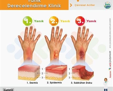 Yanık Tedavisinde Doğal ve Klinik Yaklaşımların Uyumlu Kullanımının Avantajları Yanık Tedavisinde Doğal ve Klinik Yaklaşımların Uyumlu Kullanımının Avantajları