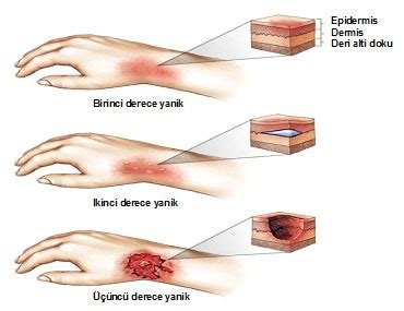 Yanık Tedavisinde İlk Yardım: Acil Durumda Doğru Müdahale Adımları Yanık Tedavisinde İlk Yardım: Acil Durumda Doğru Müdahale Adımları