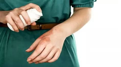 Yanık Tedavisinde Uzmanlardan Özel İpuçları: Hangi Durumlarda Ne Yapılmalı? Yanık Tedavisinde Uzmanlardan Özel İpuçları: Hangi Durumlarda Ne Yapılmalı?