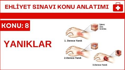 Yanık Türlerinde Doğru İlk Yardım: Bilimsel Veriler Işığında Yanık Türlerinde Doğru İlk Yardım: Bilimsel Veriler Işığında